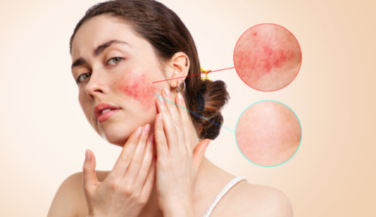 Rosacea treatment melbourne
