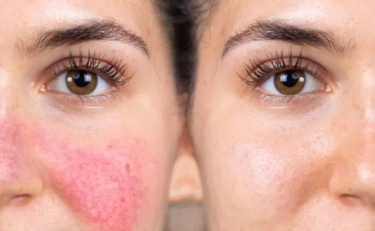 Rosacea treatment melbourne