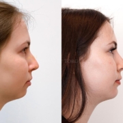 Chin Implant Toronto