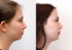 Chin Implant Toronto