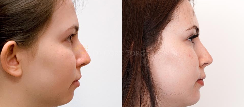 Chin Implant Toronto
