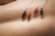 Acupuncture therapy