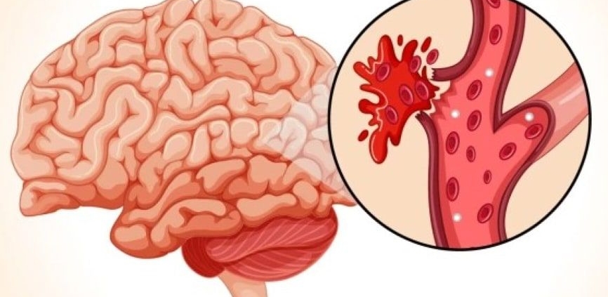 How Do I Choose the Best Neurologist in Jaipur?