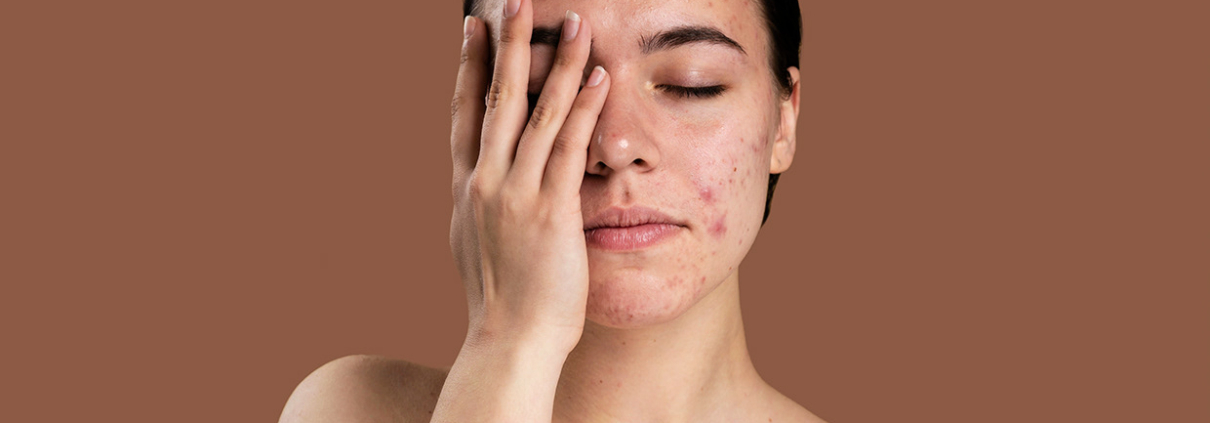 Woman with acne-prone skin considering professional Body Treatment Chevy Chase for clearer, healthier skin.