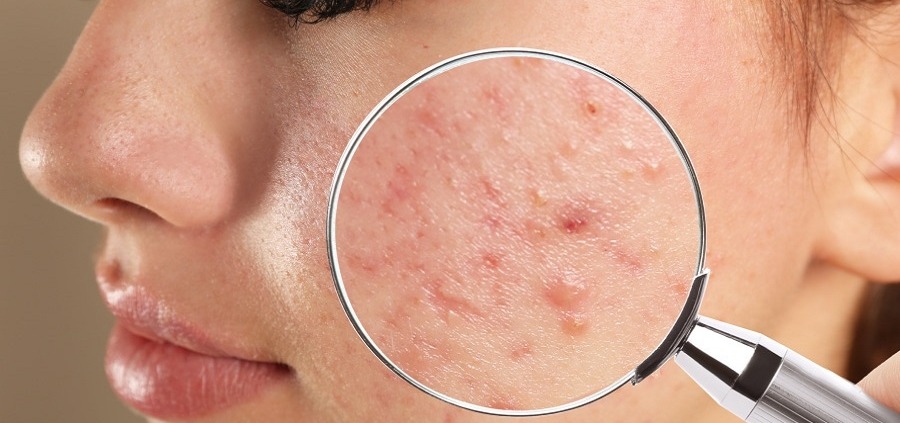 علاج حب الشباب الرياض