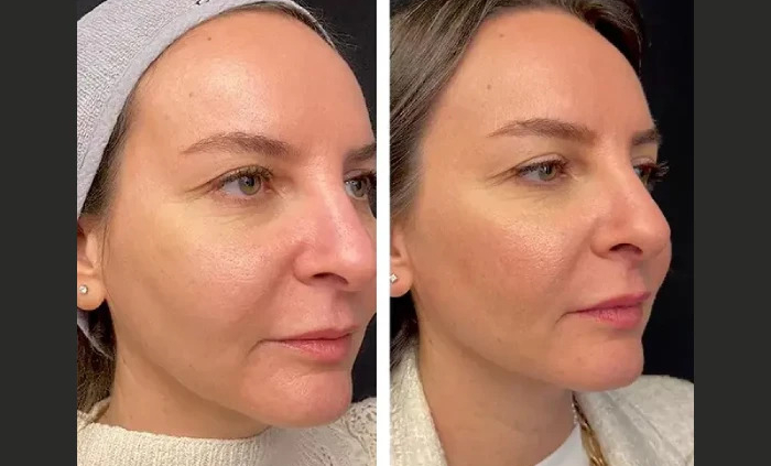 Mesotherapy in dubai