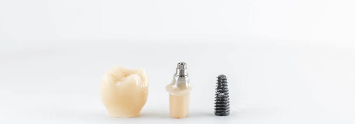 Single tooth dental implant with crown in Dubai