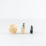 Single tooth dental implant with crown in Dubai