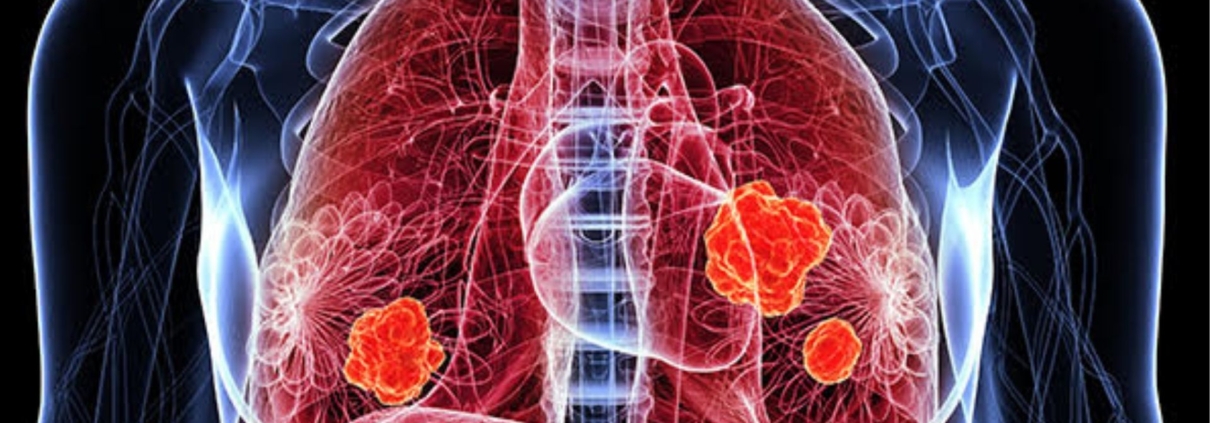 Lung Cancer Diagnostics Market