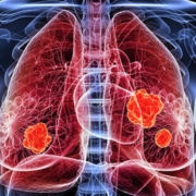 Lung Cancer Diagnostics Market