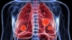 Lung Cancer Diagnostics Market