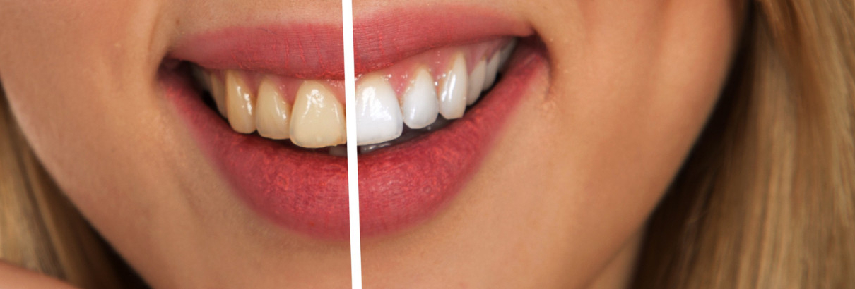 Teeth Whitening