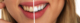 Teeth Whitening