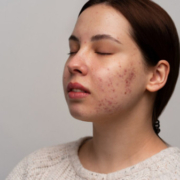 lymphatic acne