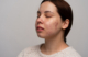 lymphatic acne