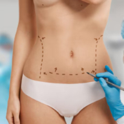 abdominoplasty surgery