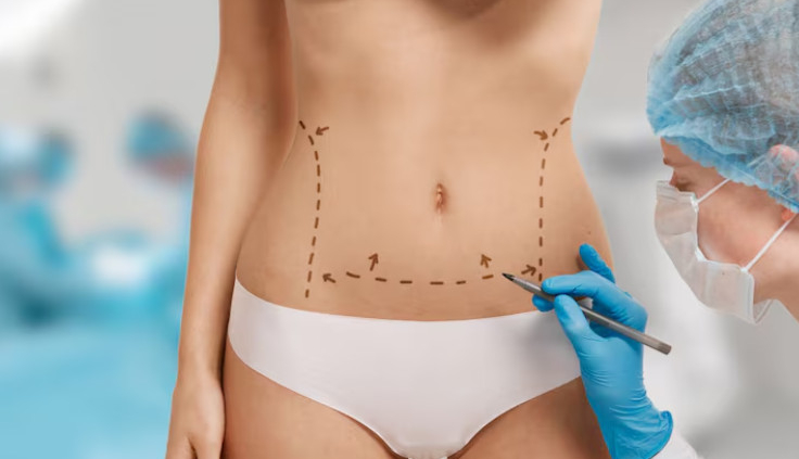 abdominoplasty surgery