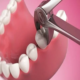 Dentist performing tooth extraction in Dubai clinic