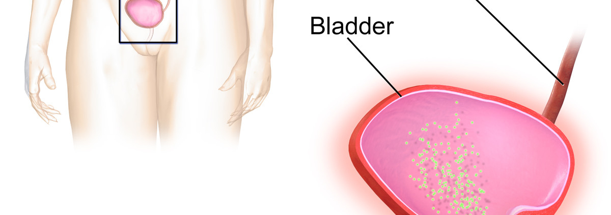 can-a-bladder-infection-cause-stomach-bloating