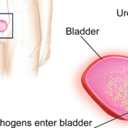 can-a-bladder-infection-cause-stomach-bloating