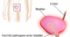 can-a-bladder-infection-cause-stomach-bloating