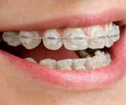Clear aligner braces