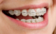 Clear aligner braces