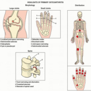 Degenerative joint disease icd 10