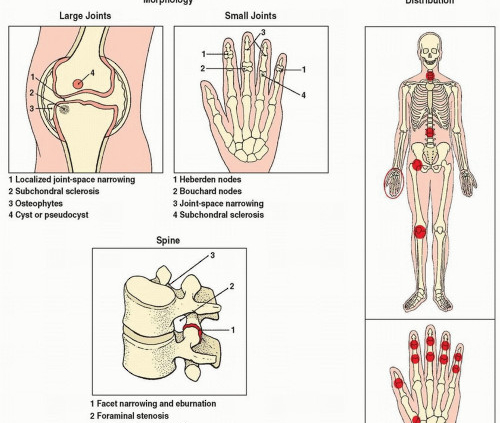 Degenerative joint disease icd 10