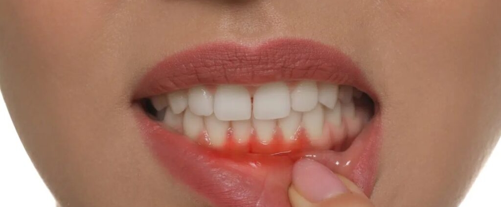 Gum Disease