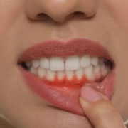 Gum Disease