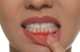 Gum Disease