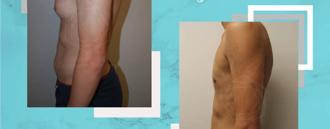 gynecomastia surgery cost in islamabad