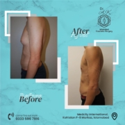 gynecomastia surgery cost in islamabad