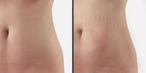 laser for stretch mark removal