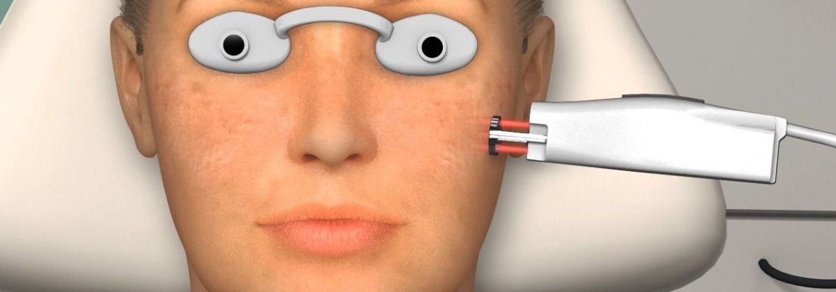 Laser Skin Resurfacing in Boynton Beach