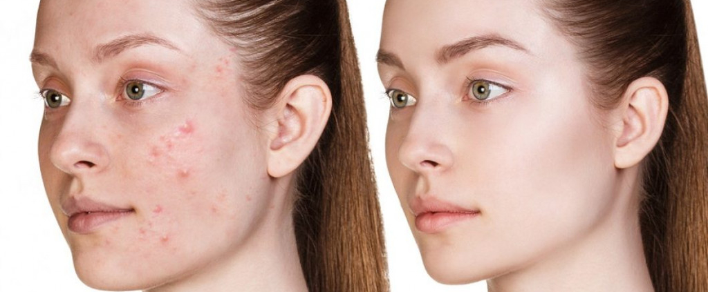 Rosacea treatment melbourne