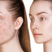 Rosacea treatment melbourne