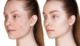 Rosacea treatment melbourne