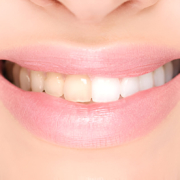Teeth Whitening in Aberdeen