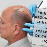 trasplante de cabello