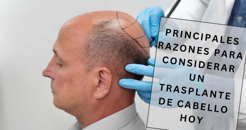 trasplante de cabello