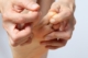 wart surgery