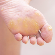 wart surgery