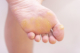 wart surgery