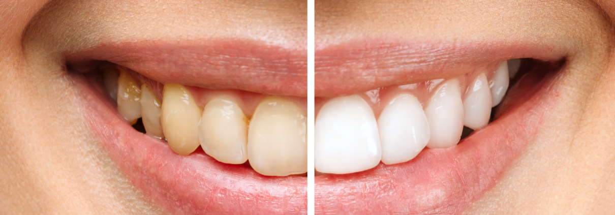 Dental Veneers