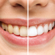Dental Veneers